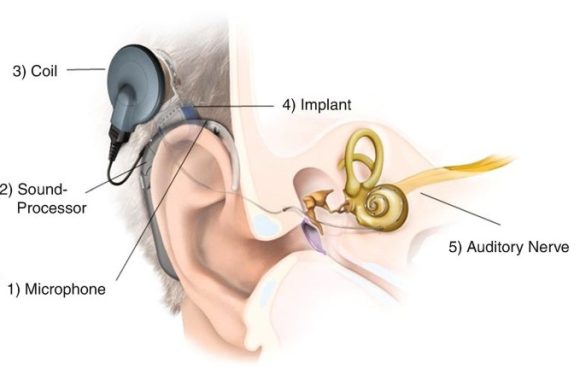 Join a cochlear implant class action lawsuit: Essential Steps